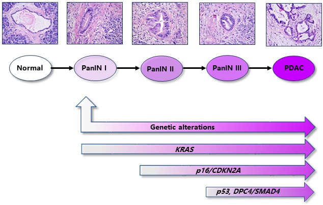 Metabolism remodeling in pancreatic ductal adenocarcinoma.