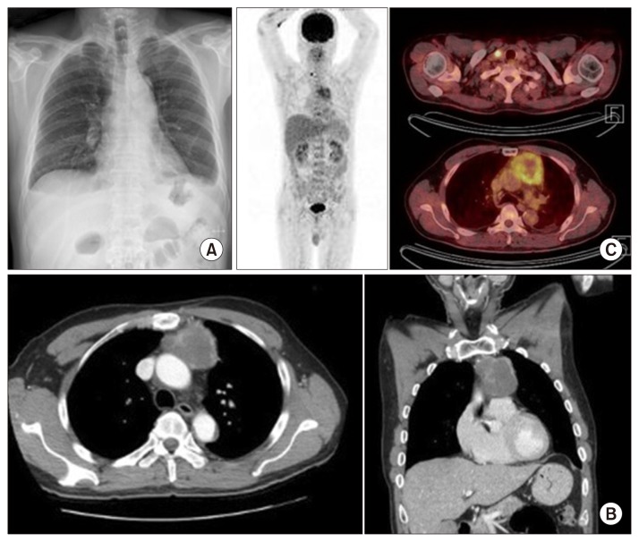 Atypical Thymic Carcinoid in a Patient with Zollinger-Ellison Syndrome.