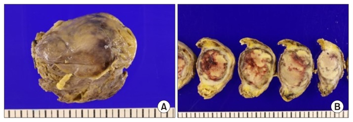 Atypical Thymic Carcinoid in a Patient with Zollinger-Ellison Syndrome.