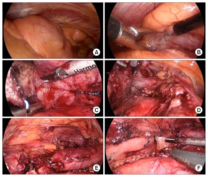 Atypical Thymic Carcinoid in a Patient with Zollinger-Ellison Syndrome.