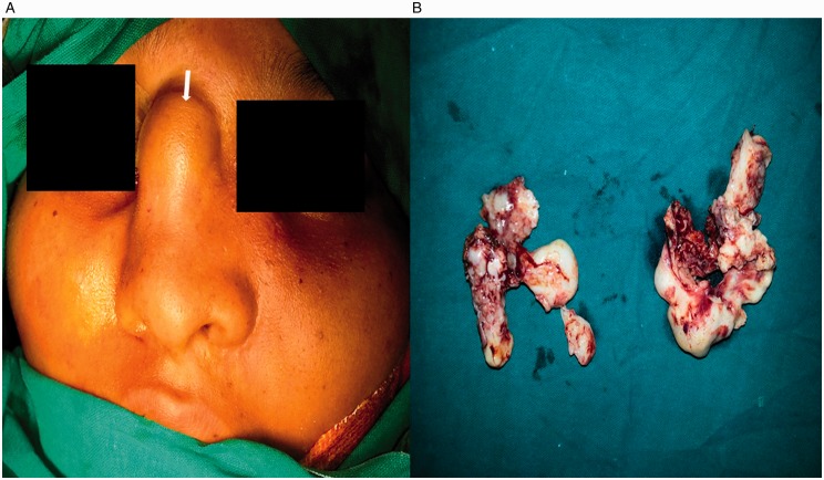 Malignant Chondroid Syringoma With Nose and Paranasal Sinus Extension: A Case Report.