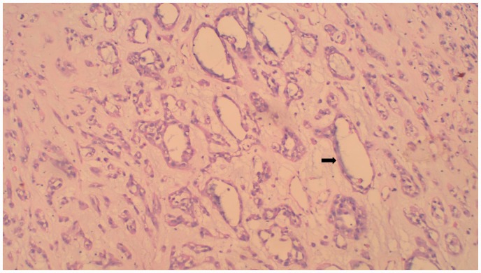 Malignant Chondroid Syringoma With Nose and Paranasal Sinus Extension: A Case Report.