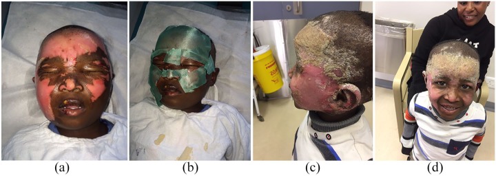 The use of a non-medicated dressing for superficial-partial thickness burns in children: a case series and review.