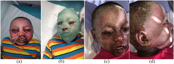 The use of a non-medicated dressing for superficial-partial thickness burns in children: a case series and review.