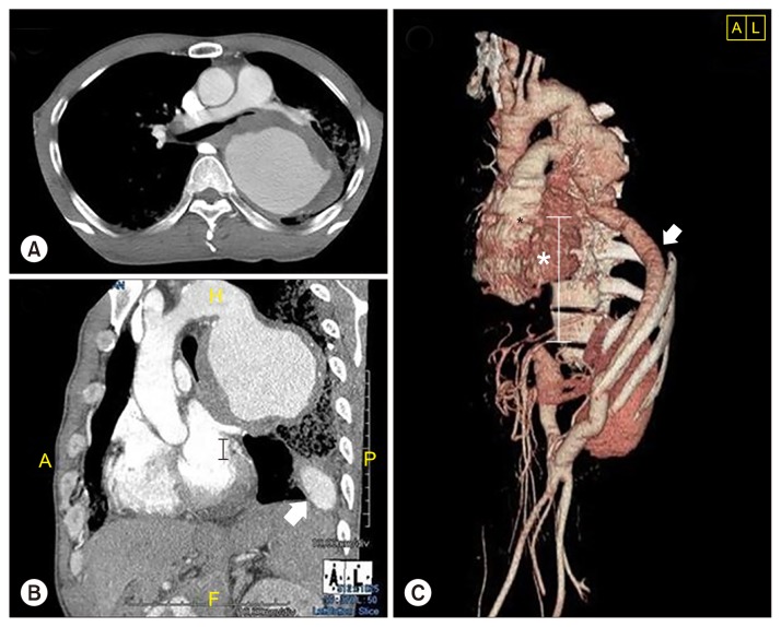 Thromboexclusion Treatment for Recurrent Aortic Aneurysm: Still an Option in Select Cases.