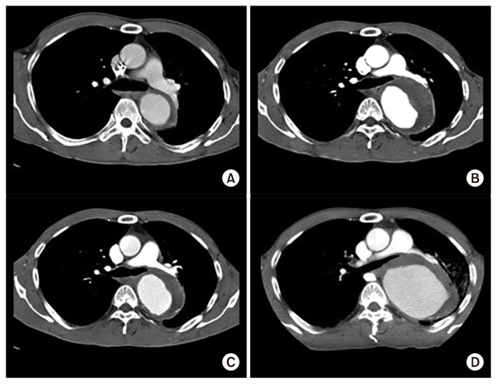 Thromboexclusion Treatment for Recurrent Aortic Aneurysm: Still an Option in Select Cases.