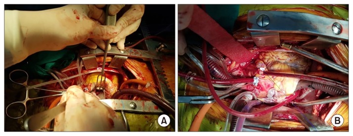 Unusual Communication between the Pulmonary Artery and Vieussens' Arterial Ring Causing Infective Endocarditis.