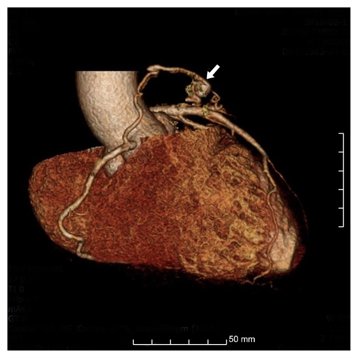 Unusual Communication between the Pulmonary Artery and Vieussens' Arterial Ring Causing Infective Endocarditis.