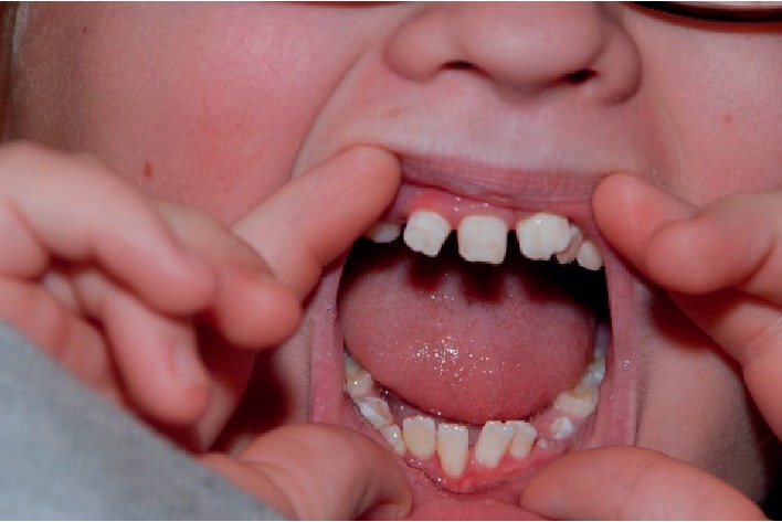 Two Cases of Oculofaciocardiodental (OFCD) Syndrome due to X-Linked BCOR Mutations Presenting with Infantile Hemangiomas: Phenotypic Overlap with PHACE Syndrome.