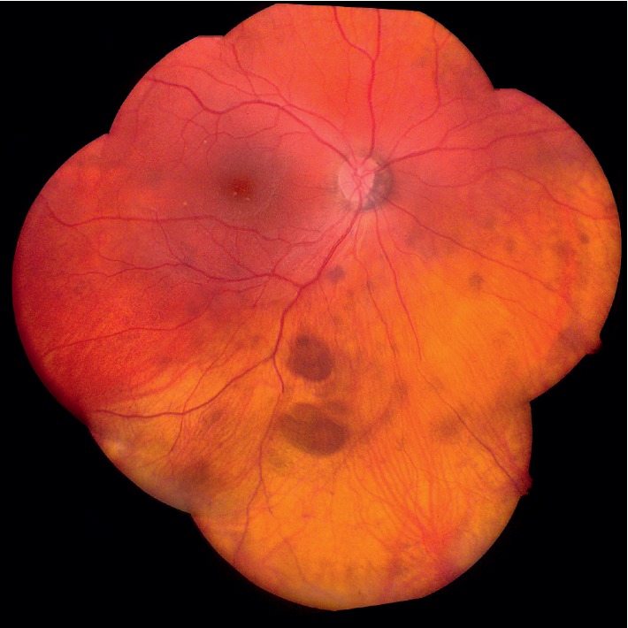 Two Cases of Oculofaciocardiodental (OFCD) Syndrome due to X-Linked BCOR Mutations Presenting with Infantile Hemangiomas: Phenotypic Overlap with PHACE Syndrome.