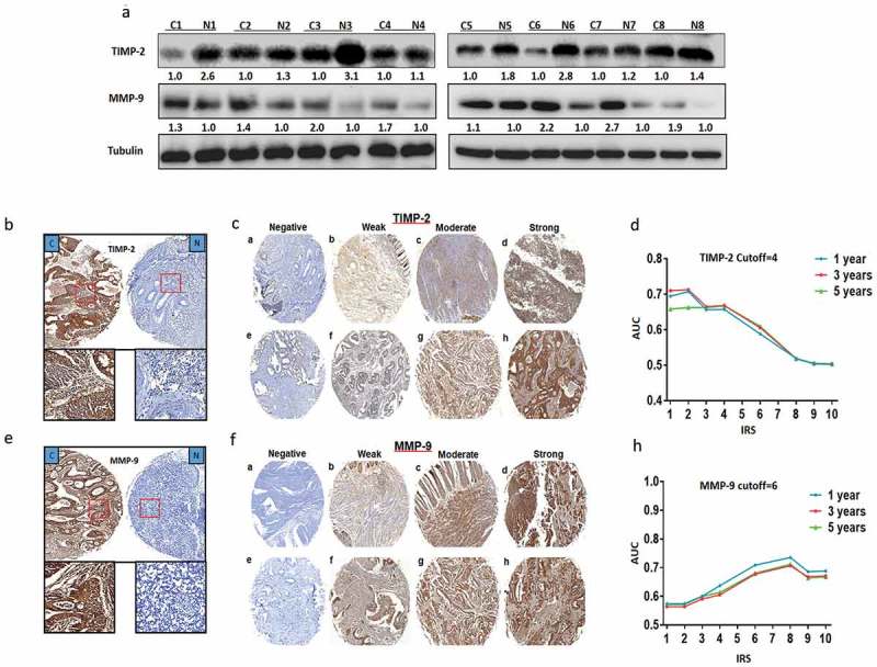 TIMP-2 inhibits metastasis and predicts prognosis of colorectal cancer via regulating MMP-9.