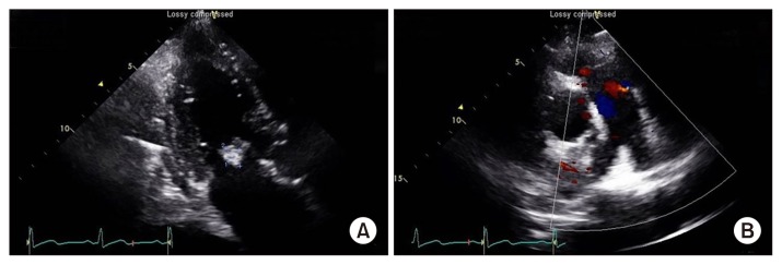 Unusual Communication between the Pulmonary Artery and Vieussens' Arterial Ring Causing Infective Endocarditis.