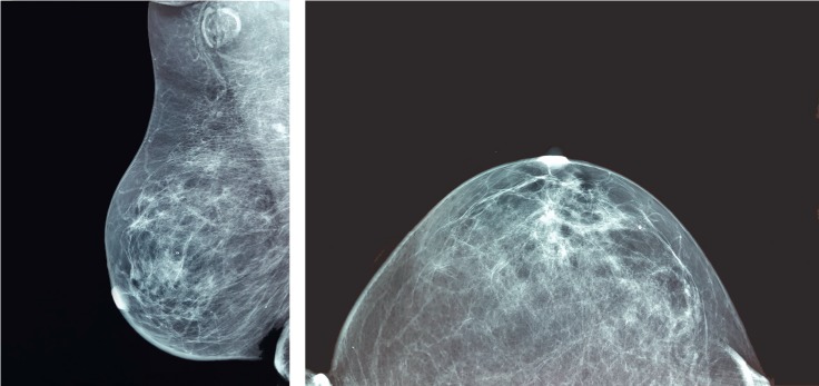 Hodgkin Lymphoma Mimicking Inflammatory Breast Carcinoma: A Rare Case with Diagnostic Challenge and Novel Treatment.