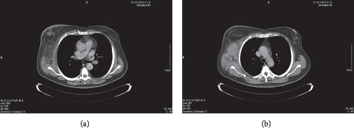 Hodgkin Lymphoma Mimicking Inflammatory Breast Carcinoma: A Rare Case with Diagnostic Challenge and Novel Treatment.