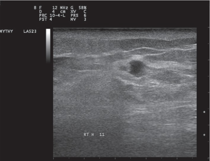 Hodgkin Lymphoma Mimicking Inflammatory Breast Carcinoma: A Rare Case with Diagnostic Challenge and Novel Treatment.