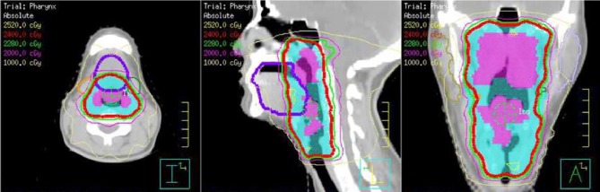 Sirolimus for the Treatment of Airway Obstruction due to Indolent T-Lymphoblastic Proliferation.