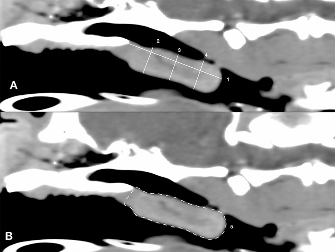 Intraobserver and interobserver reliability of computed tomography measurements of the soft palate in French bulldogs.