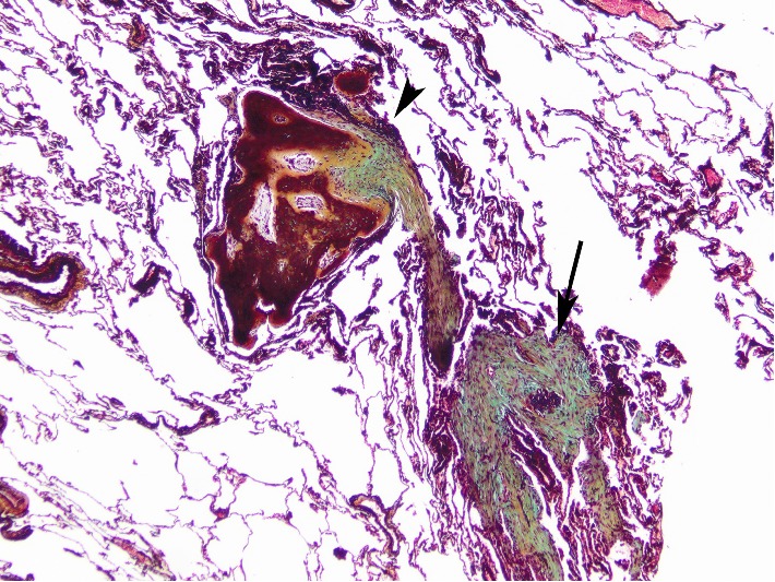 Cicatricial Organizing Pneumonia with Dendriform Pulmonary Ossification: An Unusual Cause for a Recurrent Pneumothorax.