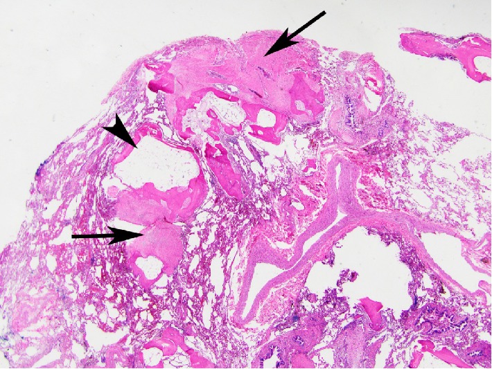 Cicatricial Organizing Pneumonia with Dendriform Pulmonary Ossification: An Unusual Cause for a Recurrent Pneumothorax.