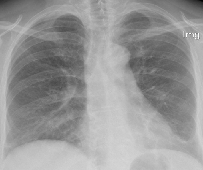 Hypersensitivity Pneumonitis Associated with Red-Vented Bulbul: A New Encounter of Bird Related Hypersensitivity Pneumonitis.