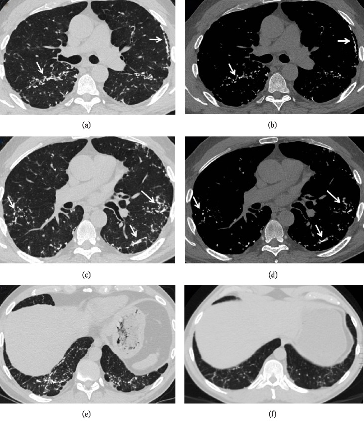 Cicatricial Organizing Pneumonia with Dendriform Pulmonary Ossification: An Unusual Cause for a Recurrent Pneumothorax.