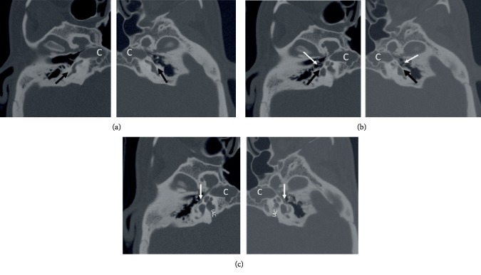 Bilateral Oval and Round Window Atresia on CT Temporal Bone: A Rare Anomaly Clinically Mimicking Otosclerosis in an Adult.