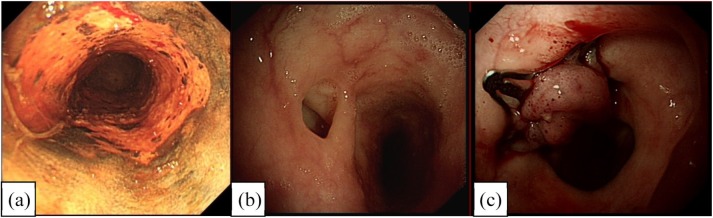 Management of spontaneous and iatrogenic perforations, leaks and fistulae of the upper gastrointestinal tract.