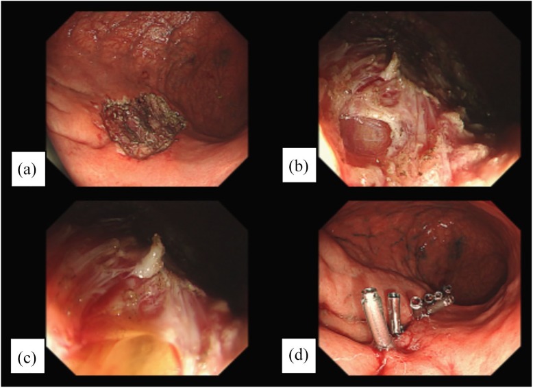 Management of spontaneous and iatrogenic perforations, leaks and fistulae of the upper gastrointestinal tract.