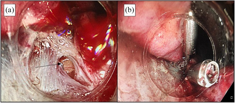 Management of spontaneous and iatrogenic perforations, leaks and fistulae of the upper gastrointestinal tract.