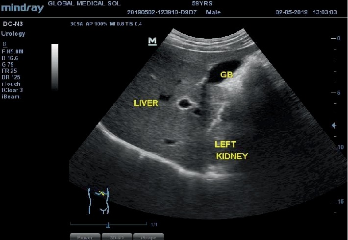 Incidental Finding of Dextrocardia with Situs Inversus in a 59-Year-Old Man.