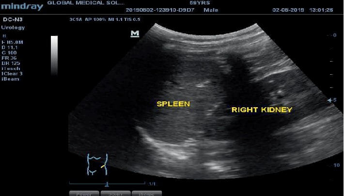 Incidental Finding of Dextrocardia with Situs Inversus in a 59-Year-Old Man.