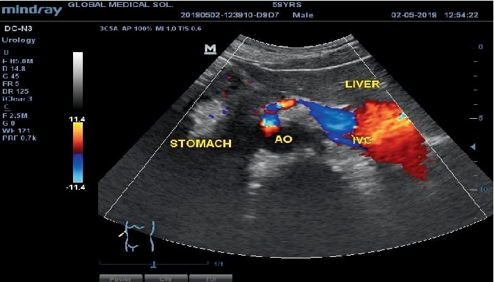 Incidental Finding of Dextrocardia with Situs Inversus in a 59-Year-Old Man.