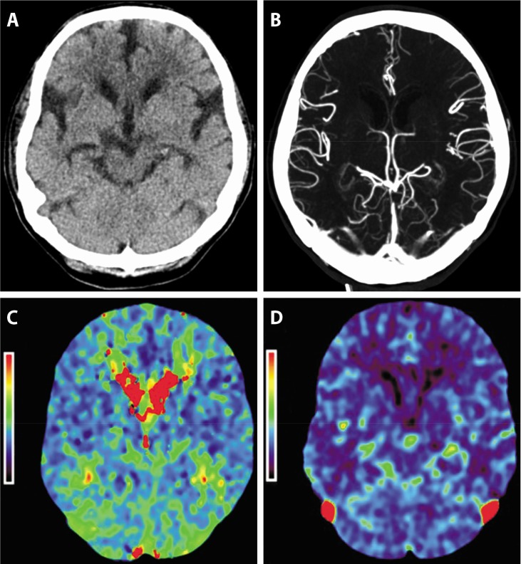 Severe Hypophosphatemia-Induced Acute Toxic-Metabolic Encephalopathy in Continuous Renal Replacement Therapy.