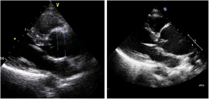 A review of thoracic aortic aneurysm disease.