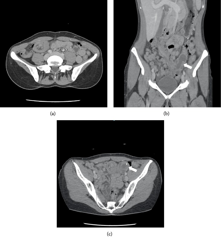 Adult Ileocolic Intussusception from the Appendix.