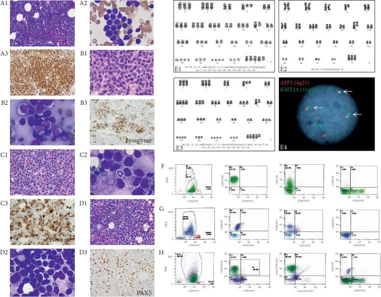 Immunotherapy- (Blinatumomab-) Related Lineage Switch of <i>KMT2A/AFF1</i> Rearranged B-Lymphoblastic Leukemia into Acute Myeloid Leukemia/Myeloid Sarcoma and Subsequently into B/Myeloid Mixed Phenotype Acute Leukemia.