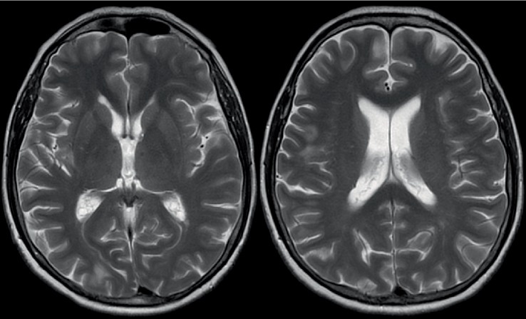 Headache and MRI Changes after Endovascular Treatment of a Cerebral Aneurysm.