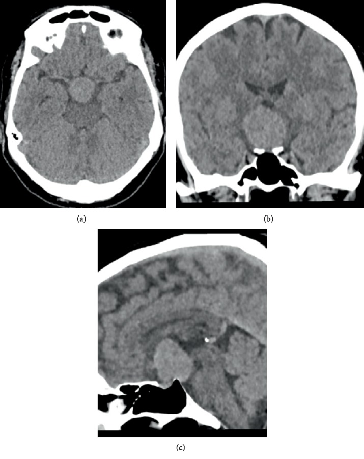 Chordoid Glioma as a Differential Diagnosis of Anterior Third Ventricle Tumours: A Rare Case Report and Five-Year Follow-Up.