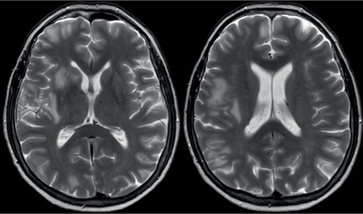 Headache and MRI Changes after Endovascular Treatment of a Cerebral Aneurysm.