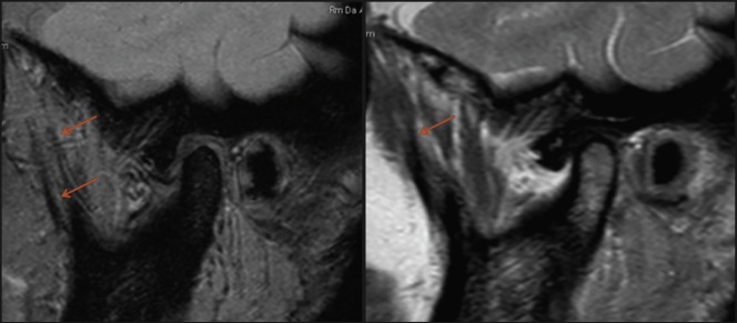 Myositis Ossificans Traumatica of the Temporal Muscle: a Case Report and Literature Review Emphasizing Radiographic Features on Computed Tomography and Magnetic Resonance Imaging.