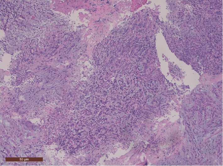 Chordoid Glioma as a Differential Diagnosis of Anterior Third Ventricle Tumours: A Rare Case Report and Five-Year Follow-Up.