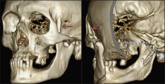 Myositis Ossificans Traumatica of the Temporal Muscle: a Case Report and Literature Review Emphasizing Radiographic Features on Computed Tomography and Magnetic Resonance Imaging.