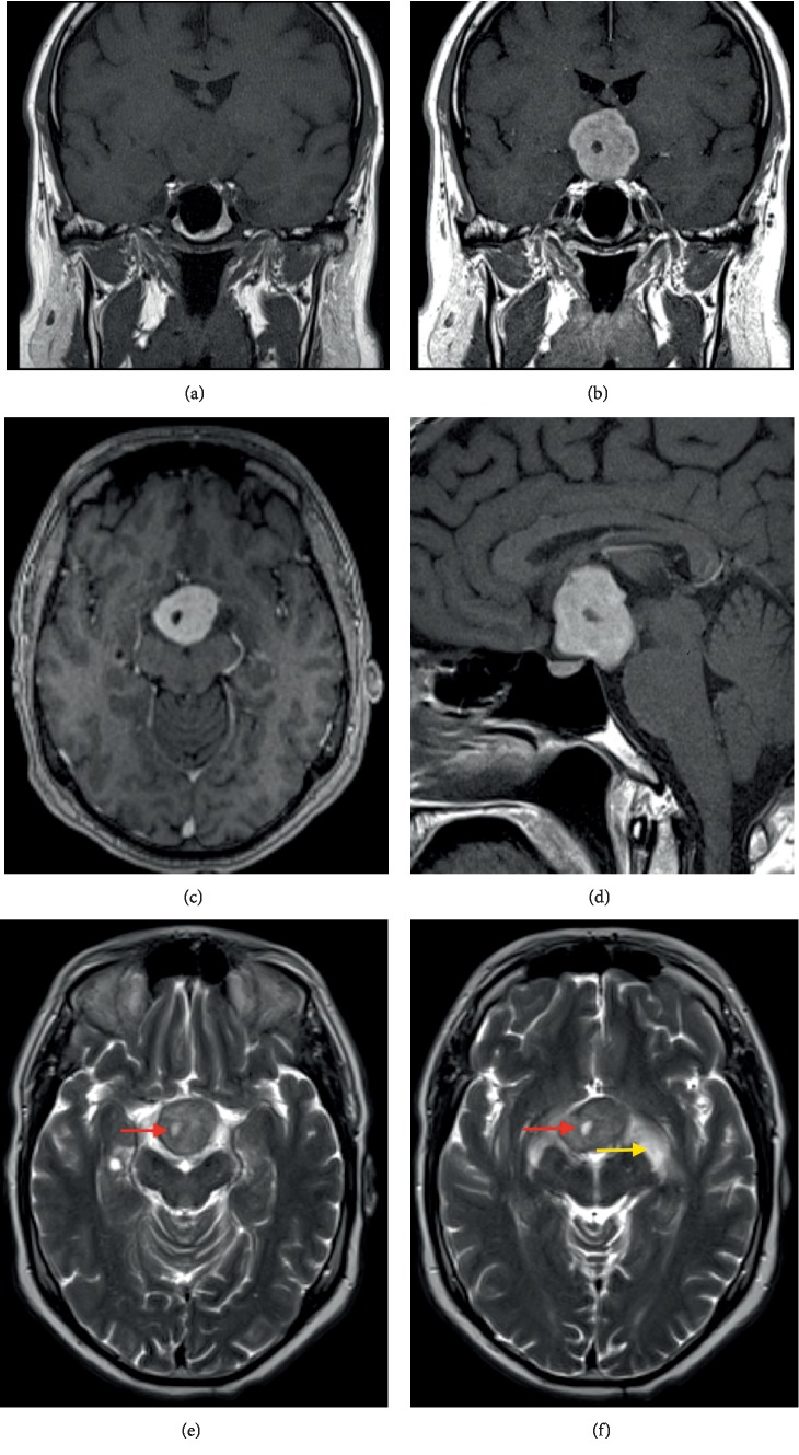 Chordoid Glioma as a Differential Diagnosis of Anterior Third Ventricle Tumours: A Rare Case Report and Five-Year Follow-Up.