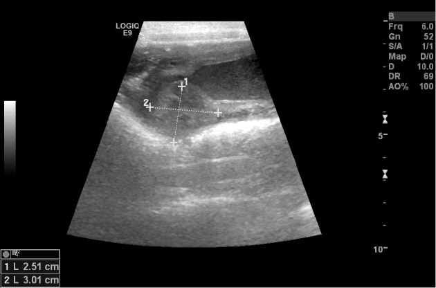 Ovariohysterectomy and Partial Vaginectomy for Treatment of Cervicovaginitis in a Dog.