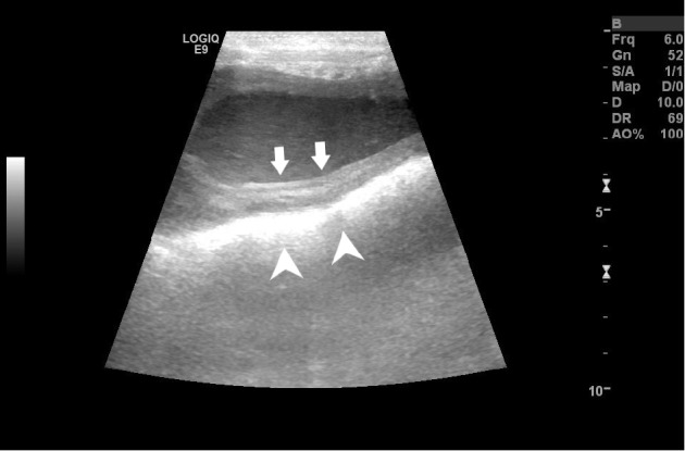 Ovariohysterectomy and Partial Vaginectomy for Treatment of Cervicovaginitis in a Dog.