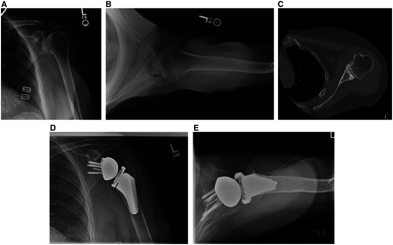 Reverse Shoulder Arthroplasty for B2 Glenoid Deformity.