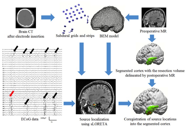 Clinical Relevance of Interictal Spikes in Tumor-Related Epilepsy: An Electrocorticographic Study.