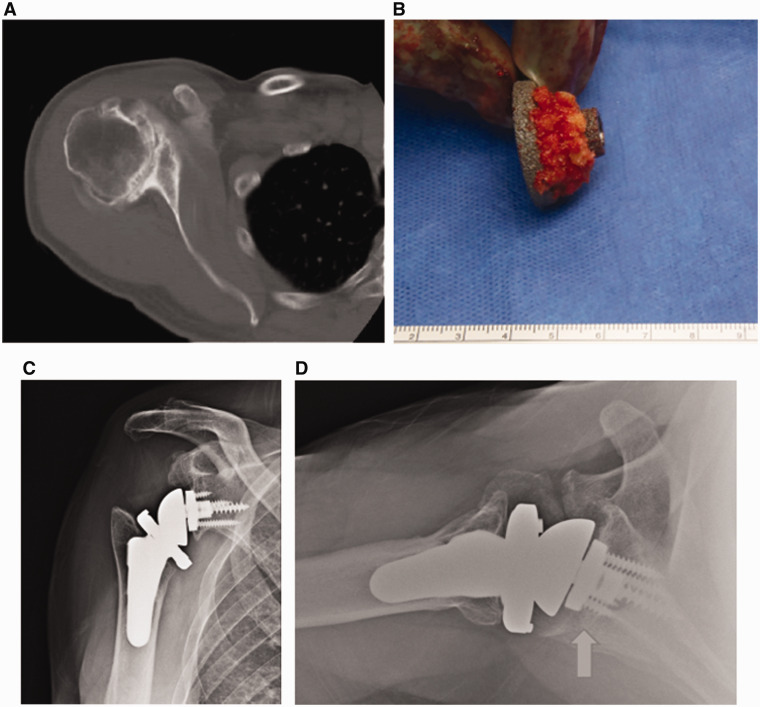 Reverse Shoulder Arthroplasty for B2 Glenoid Deformity.