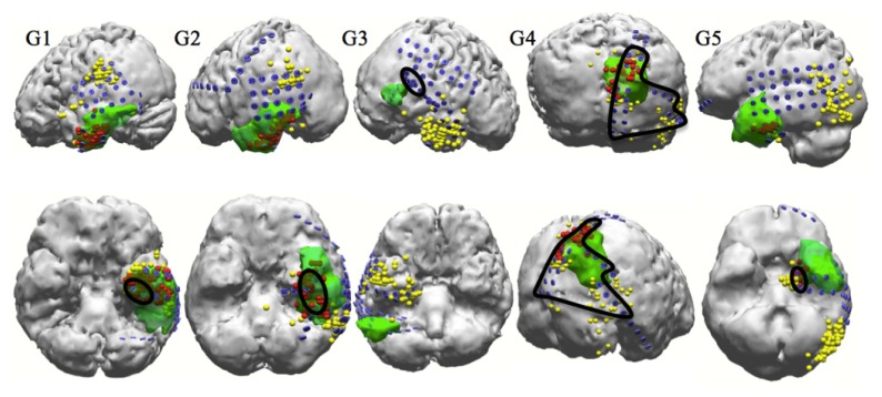 Clinical Relevance of Interictal Spikes in Tumor-Related Epilepsy: An Electrocorticographic Study.