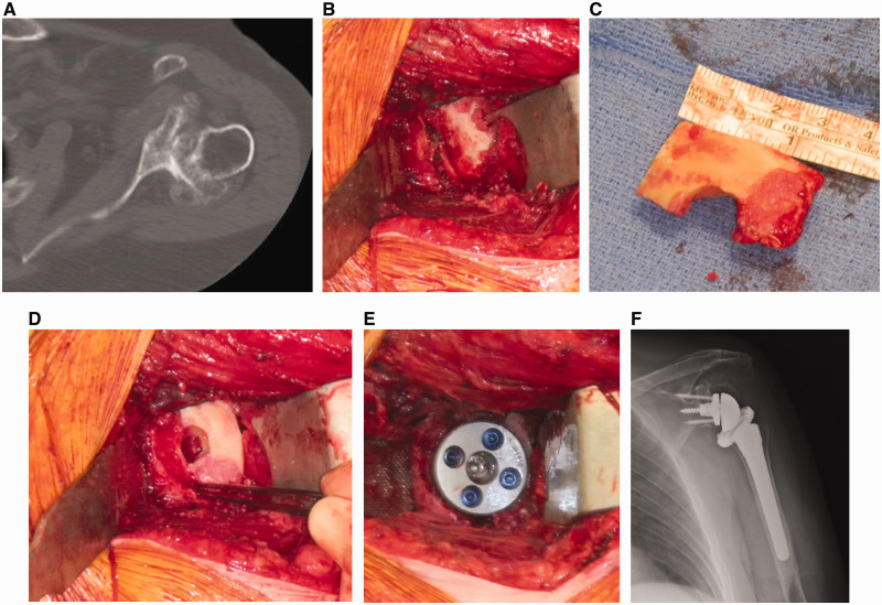 Reverse Shoulder Arthroplasty for B2 Glenoid Deformity.